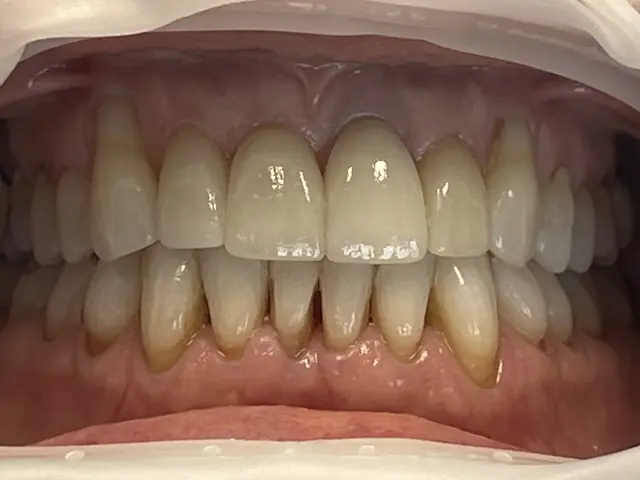 bright white smile after whitening treatment