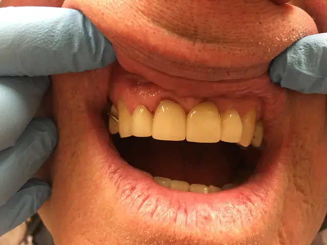 bright white smile after whitening treatment