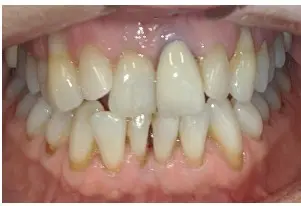 yellow stained teeth before whitening treatment
