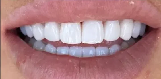 bright white smile after whitening treatment