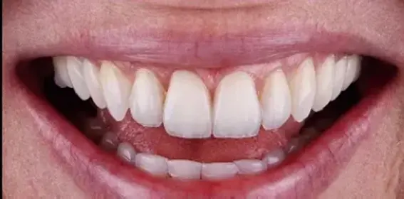 straight teeth after treatment
