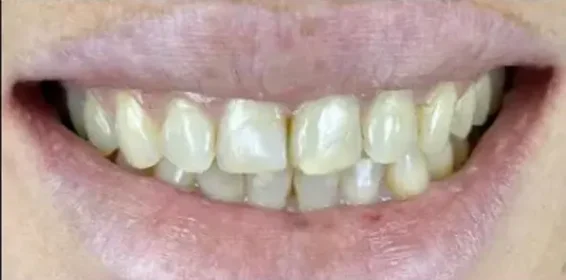 yellow stained teeth before whitening treatment