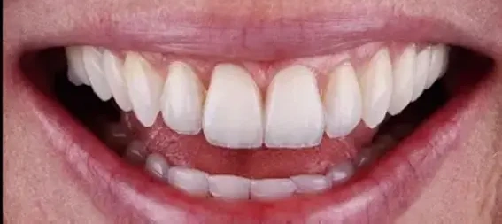 straight teeth after treatment
