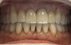bright white smile after whitening treatment
