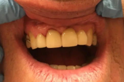 bright white smile after whitening treatment
