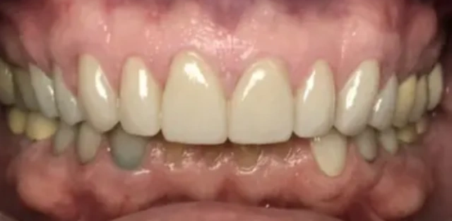 bright white smile after whitening treatment