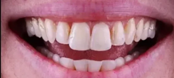 dental alignment issues before treatment