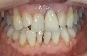 yellow stained teeth before whitening treatment