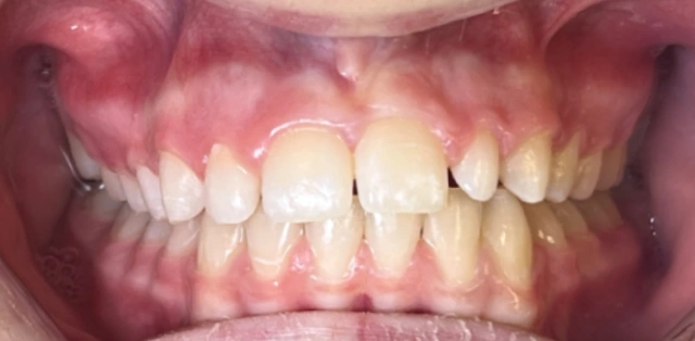 yellow stained teeth before whitening treatment