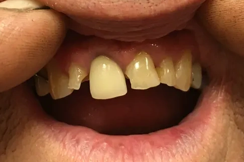 yellow stained teeth before whitening treatment