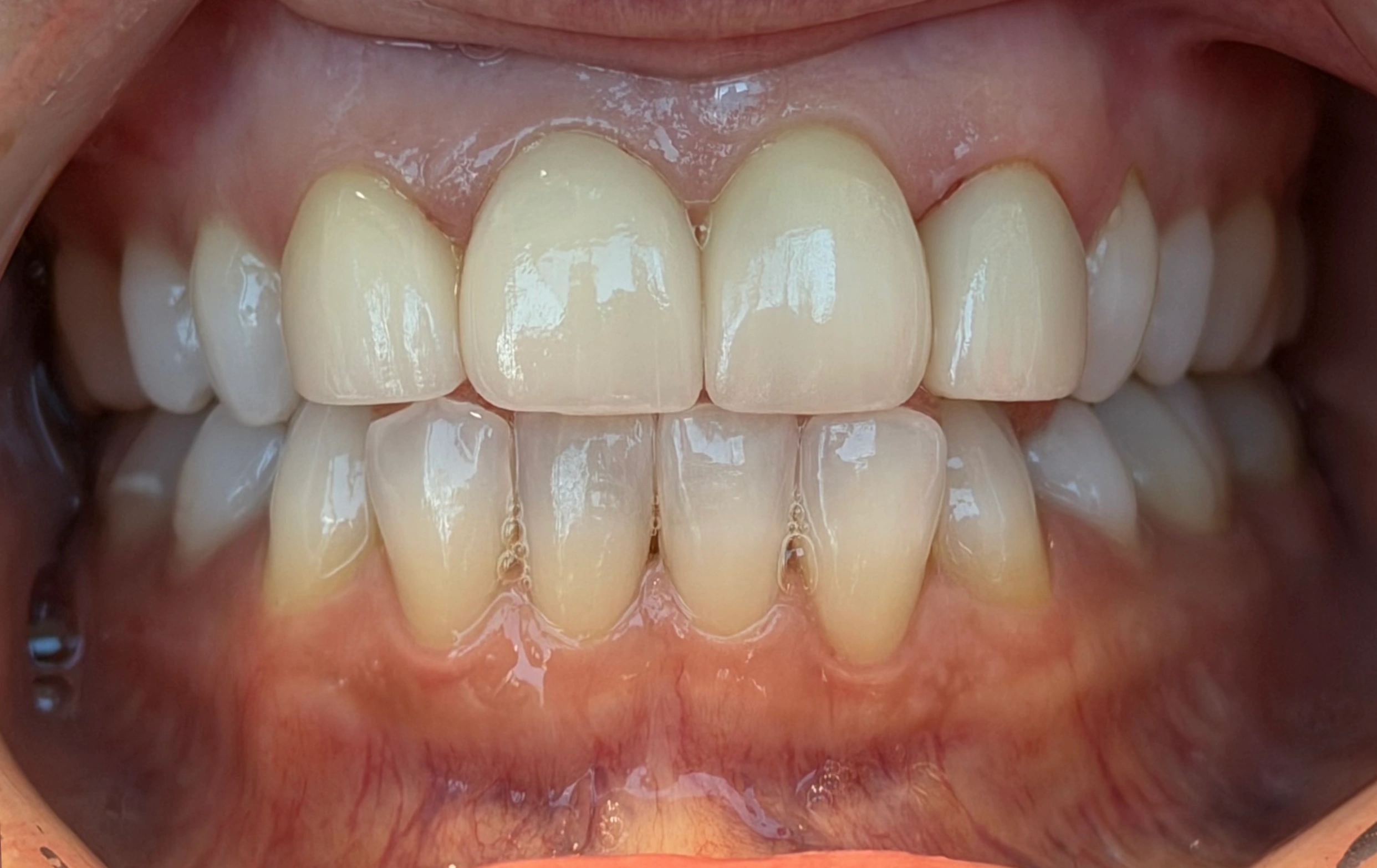 bright white smile after whitening treatment