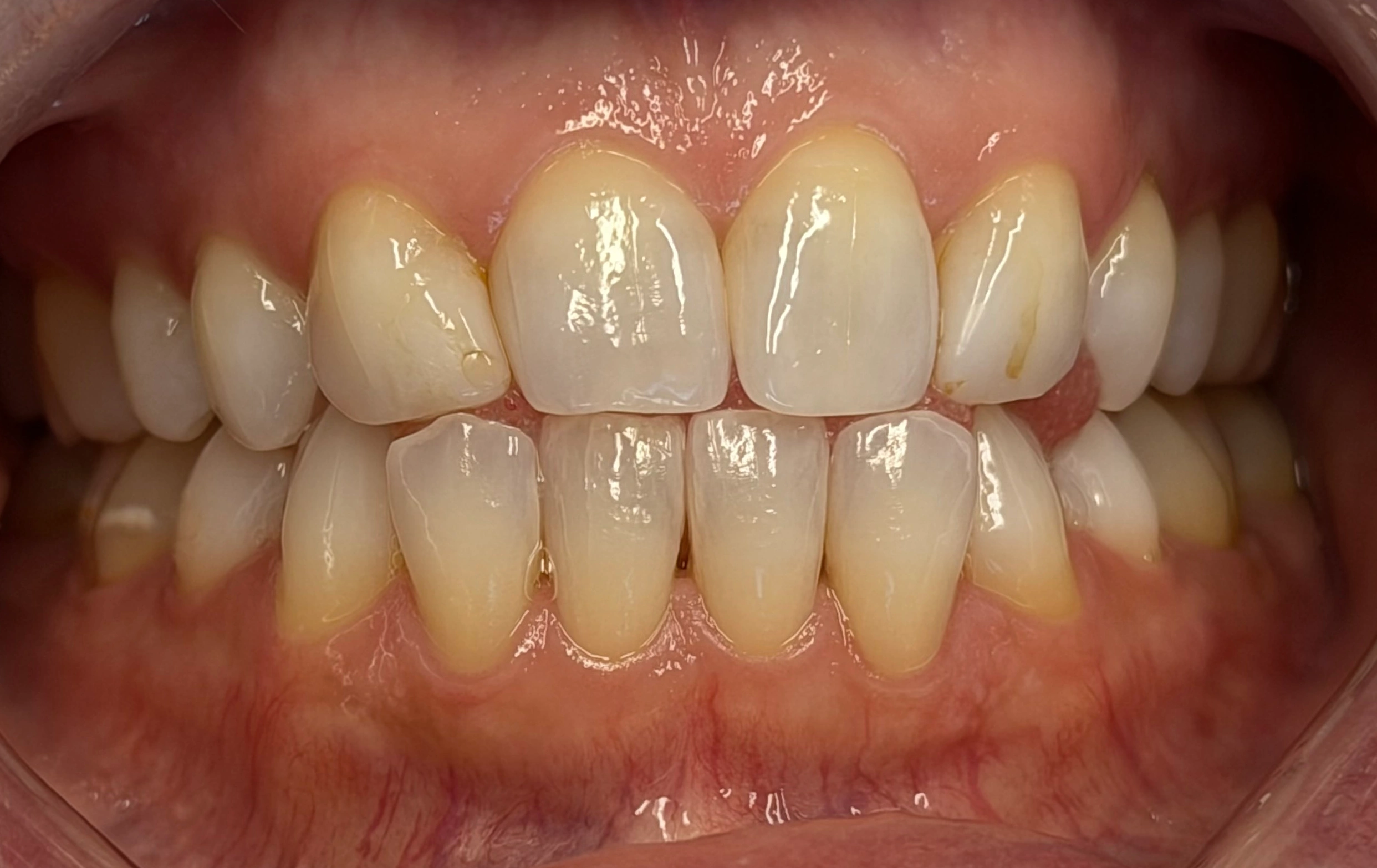 yellow stained teeth before whitening treatment